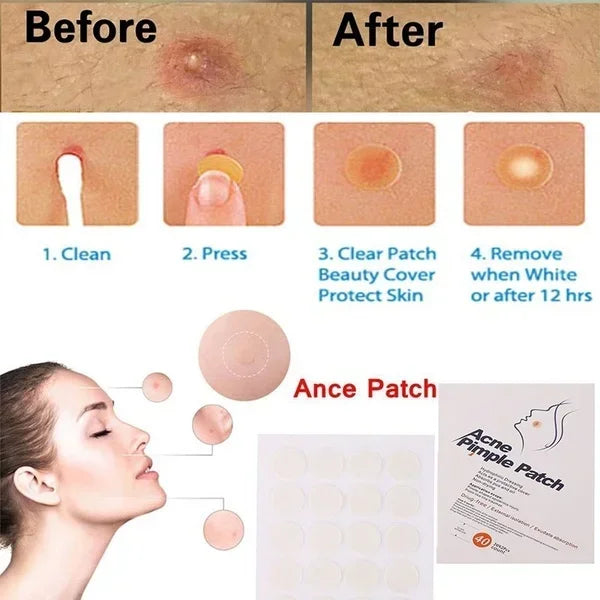 24pcs Face Acne Pimple Spot Facial Skin Care Blackhead Removal Freckle